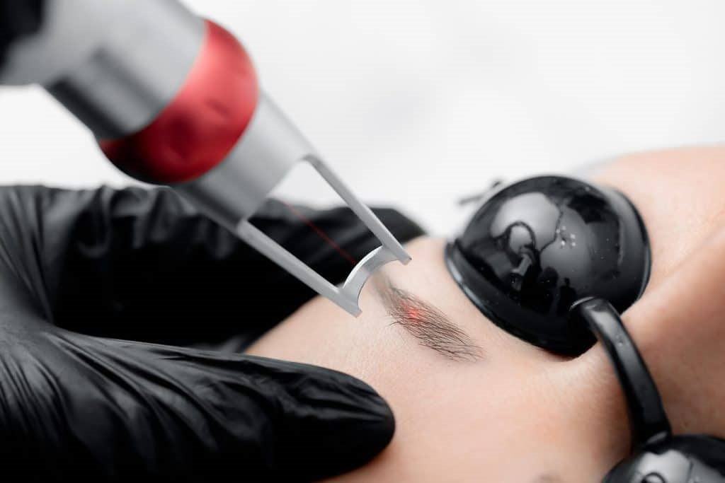 Laser Tattoo Removal